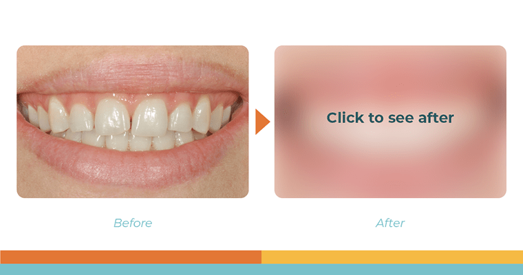 Dental Bonding Before and After Photos, Smile Makeover